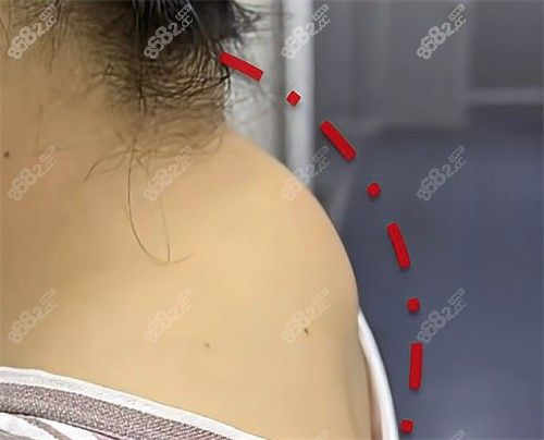 富貴包手術(shù)可以保醫(yī)療報銷嗎？