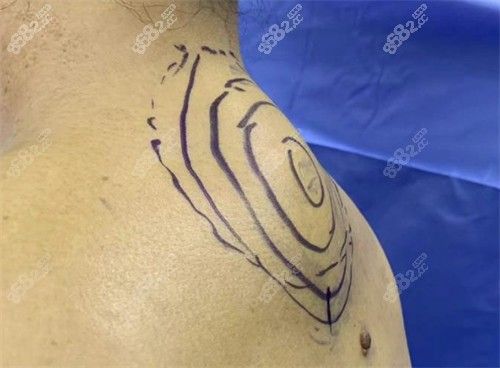 富貴包手術(shù)大概多少錢？
