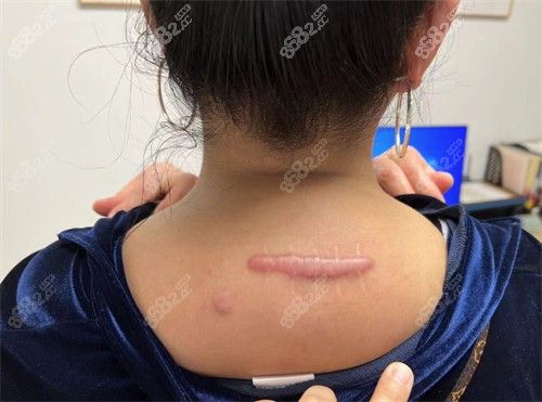 富貴包矯正多少錢