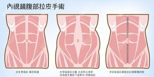 腹壁成型手術(shù)價(jià)格表分享www.8682.cc.jpg