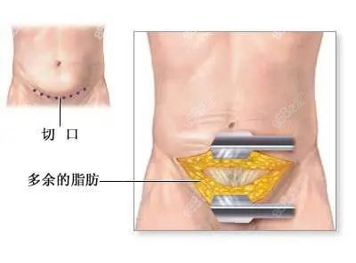 腹壁成型手術(shù)價(jià)目表分享m.8682.cc.jpg