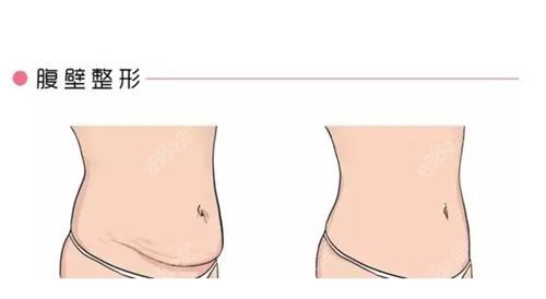 腹壁成型手術(shù)價(jià)格匯總.jpg