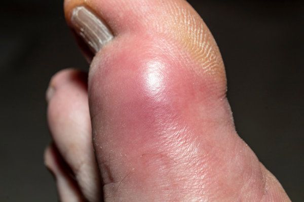 腳趾撞傷一個月不消腫