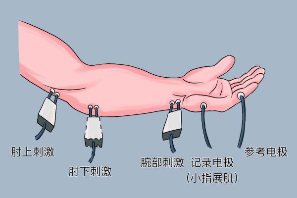 運(yùn)動(dòng)傳導(dǎo)速度測(cè)定方法圖