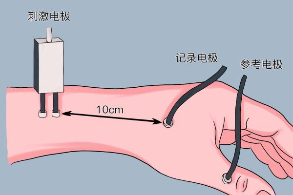 感覺(jué)神經(jīng)傳導(dǎo)速度測(cè)定方法圖