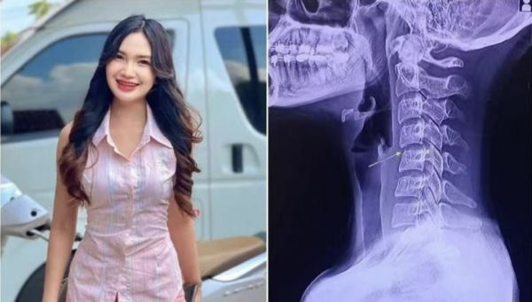 26歲男子頸部按摩后腦梗死，暴力按摩引起血管撕脫！曾有明星因此去世