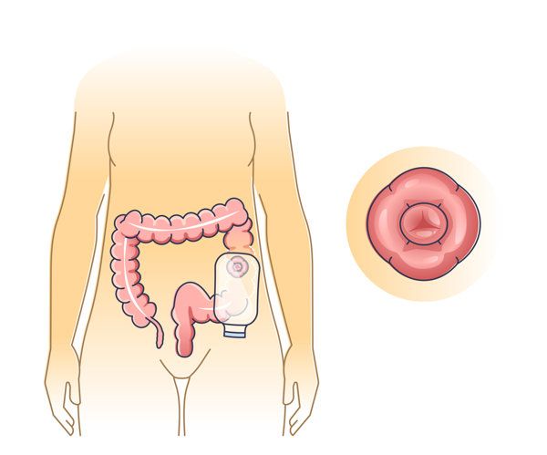 直肠癌手术三年了还会复发吗