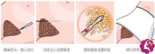 腰腹吸脂手术过程