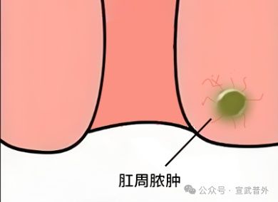 “菊”部地區(qū)暴雨紅色預(yù)警：久坐族的自救