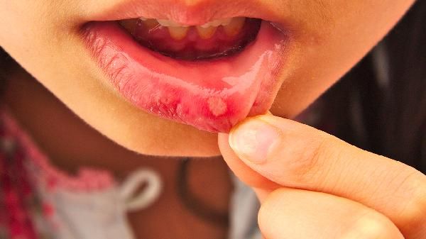 疱疹性口炎是什么原因引起的