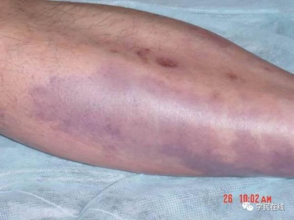 【經(jīng)典案例】患者因急性下肢缺血而來，病因卻是主動脈夾層