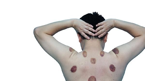 拔罐减肥需要封多少天罐