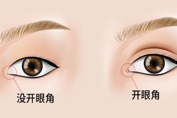 找杜园园做双眼皮修复去哪个医院？在爱尚丽格做眼睛5W起