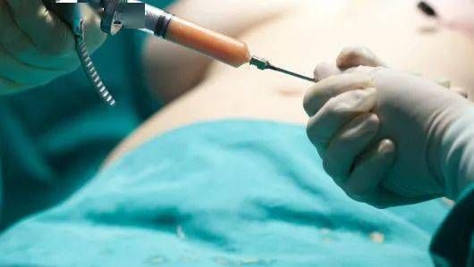 超聲波吸脂是怎樣的？