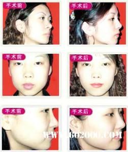 超聲吸脂術(shù)是一種什么樣的技術(shù)？