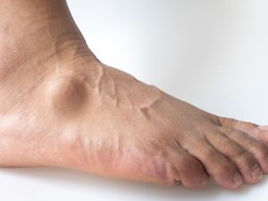 每日推薦:廣州治療痛風的醫(yī)院哪家好“榜單公開”廣州痛風醫(yī)院綜合實力排名