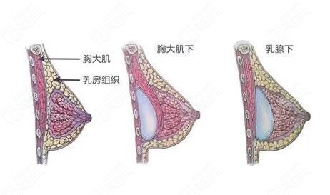 產(chǎn)后胸干癟做假體隆胸改善