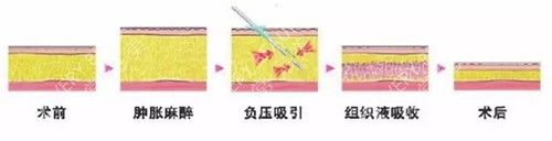 負(fù)壓吸脂簡(jiǎn)易過程示意圖