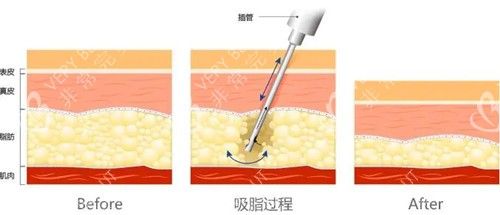 負(fù)壓吸脂前后對(duì)比示意圖