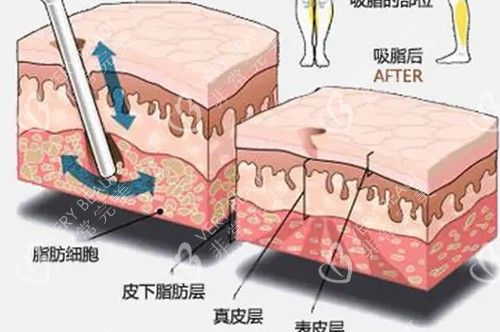 吸脂前后皮膚層次模型示意圖