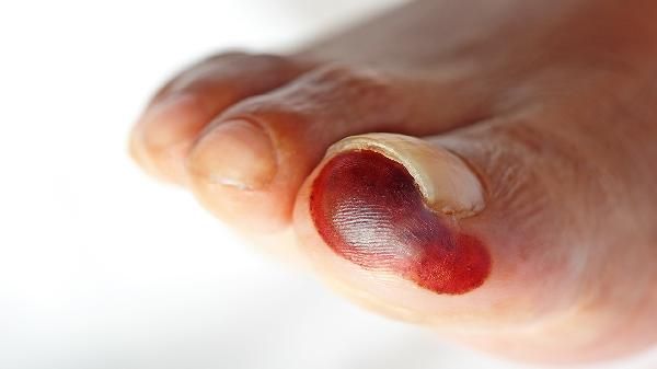 腳趾頭腫了一碰就疼怎么辦