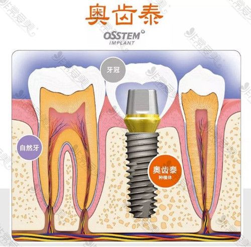 韓國奧齒泰種植體怎么樣