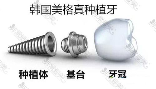 韓國美格真種植體怎么樣