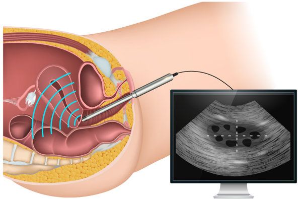 宫颈机能不全怎么检查确诊