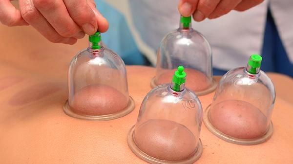 拔罐減肥反彈厲害嗎