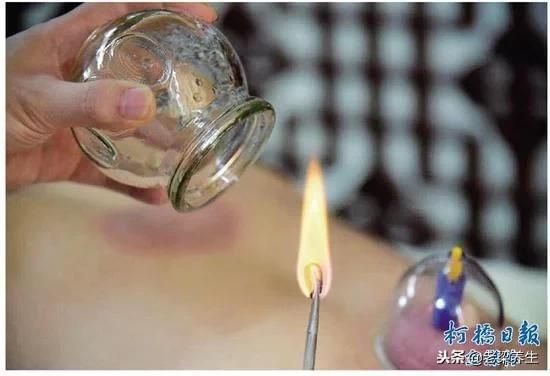 拔罐养生指南，很全面，收藏一下吧！