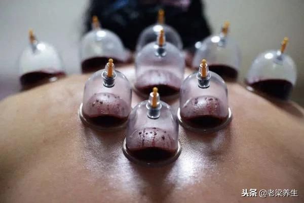 拔罐养生指南，很全面，收藏一下吧！
