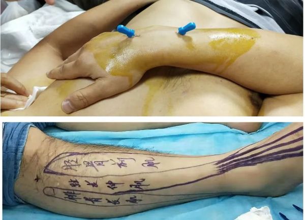 7月12日针刀医学临床应用班