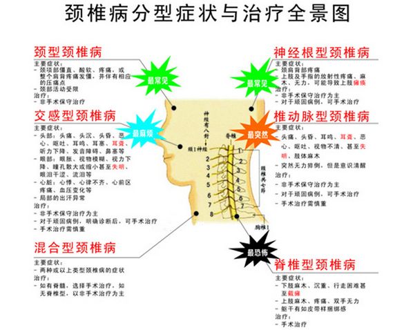 颈椎病的症状
