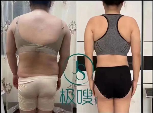 极嗖芯片减肥加盟