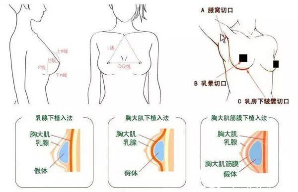 假体隆胸示意图