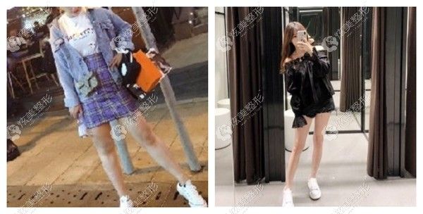 宁波艺星做大腿水动力吸脂效果图