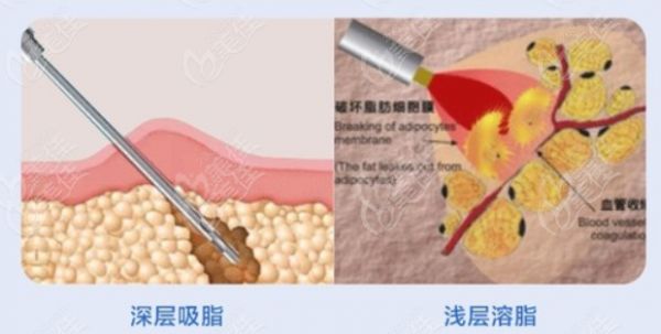 吸脂手术