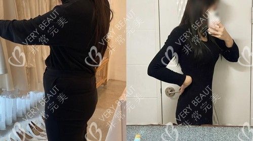 吸脂为什么要穿塑身衣