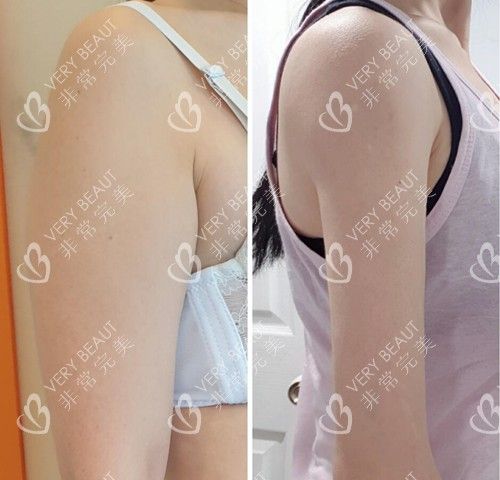 上臂吸脂前后对比图