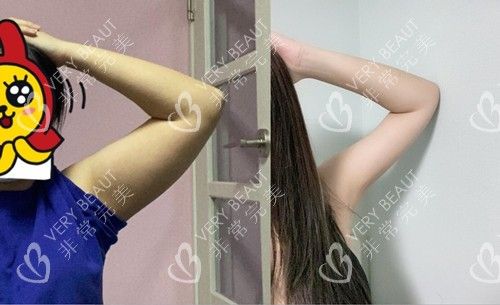 手臂吸脂对比图