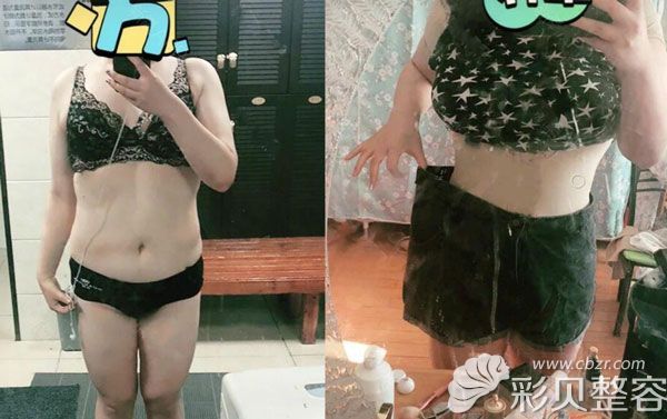 郑州天后整形医院全身抽脂10斤案例效果展示