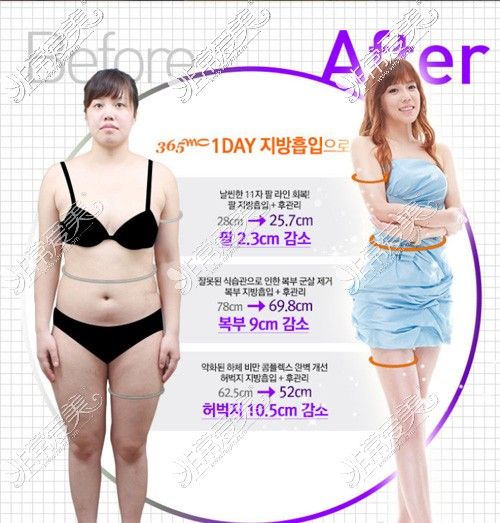 全身抽脂前后对比图