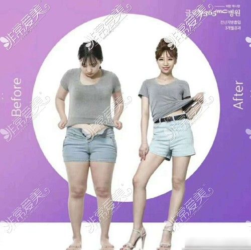 全身吸脂前后对比