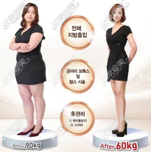 全身抽脂60斤照片