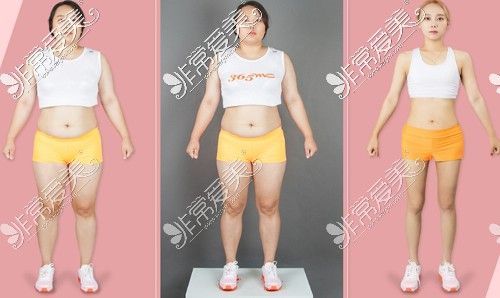 全身抽脂对比照