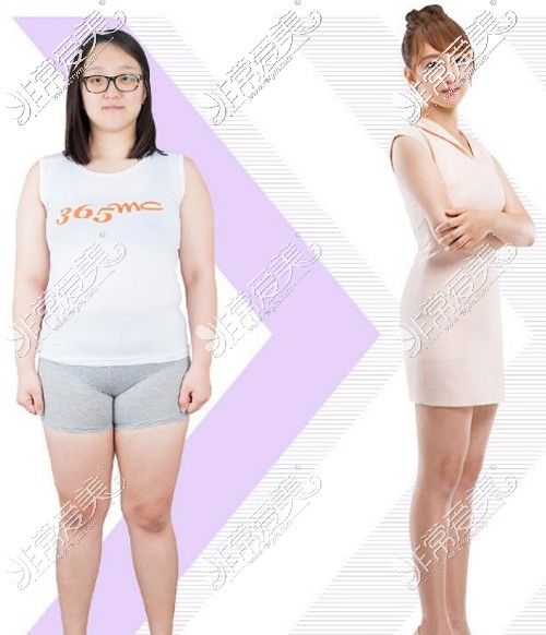 全身吸脂术前术后对比