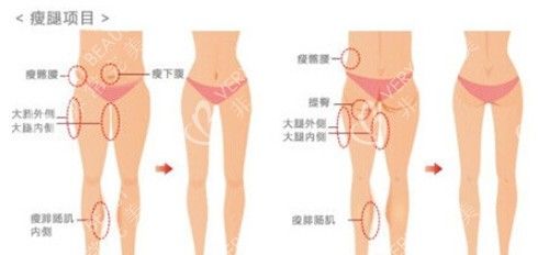 吸脂瘦腿示意图