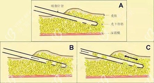 吸脂过程示意图