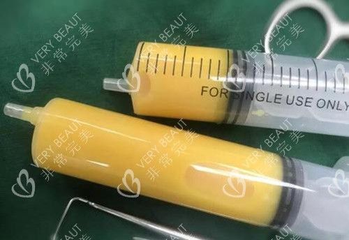 手臂吸脂脂肪示意图
