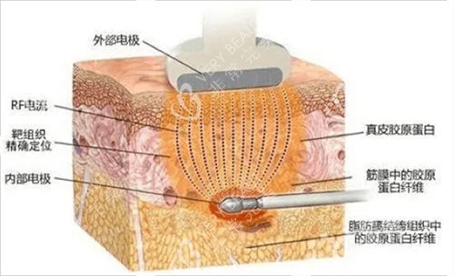 激光溶脂素材
